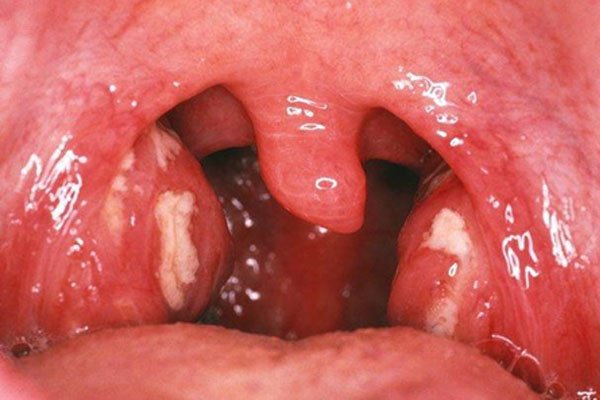 Viêm Amidan – Bệnh hô hấp thường gặp không thể chủ quan 1