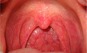 viêm họng do vi khuẩn