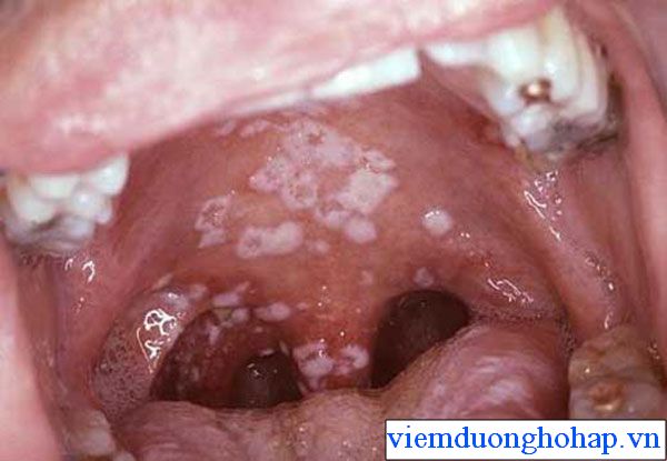 Viêm họng hạt có mủ – nguyên nhân, triệu chứng