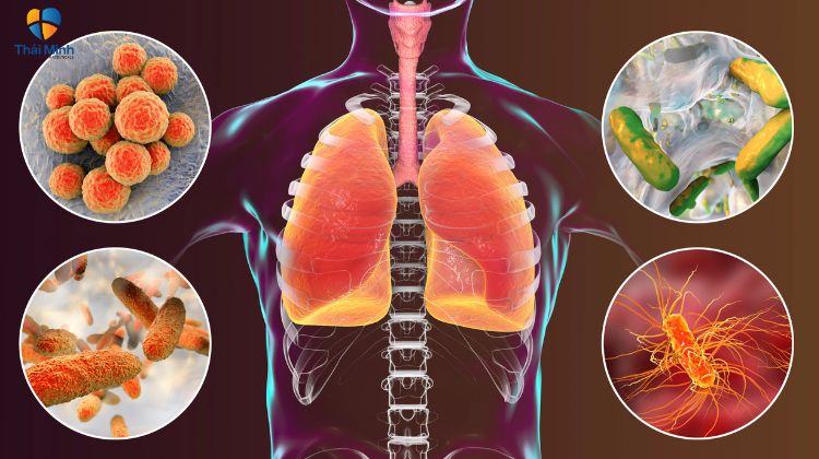 viêm phổi gây ho có đờm vàng do vi khuẩn tích trữ trong phổi