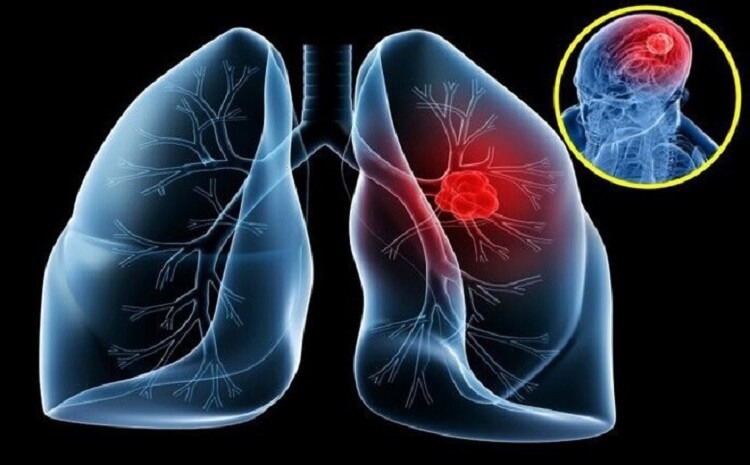 Ung thư phổi bệnh hiểm nghèo gây ho ra máu, ho nhiều ngày kèm đau tức ngực